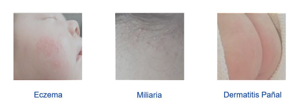 Tipos de dermatitis Bebé