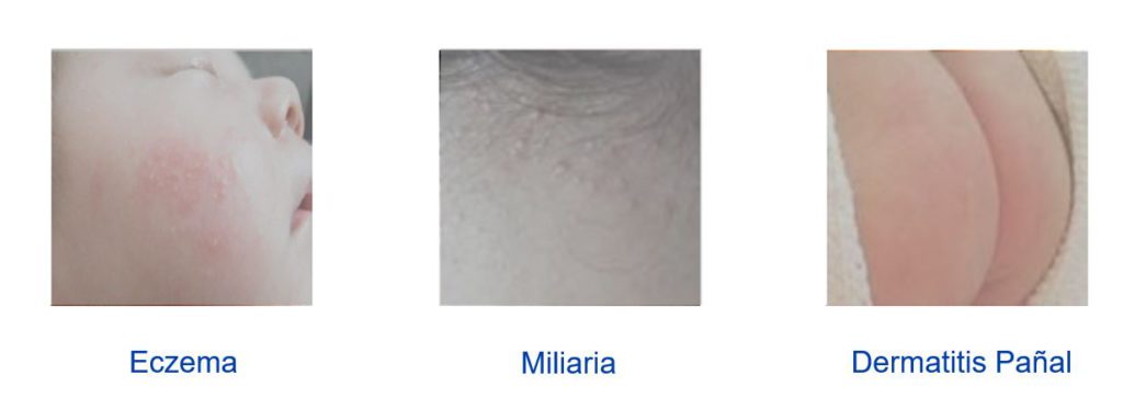 Tipos de dermatitis Bebé